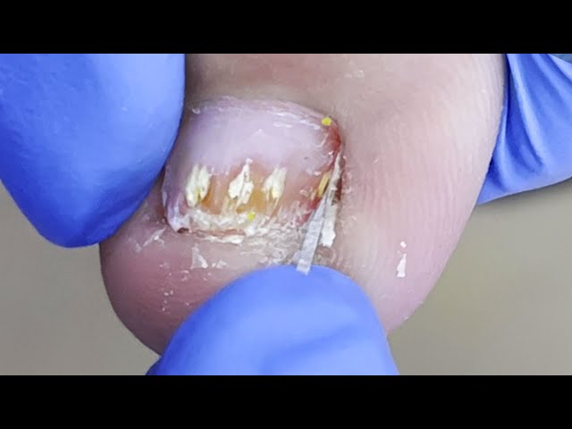 Paronychia causes swollen toes, slowly trim the edges