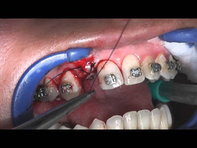 Single Tooth Crest Split & Ridge Widening at an Upper Lateral Incisor Site (Dr_Juan_Martinez)