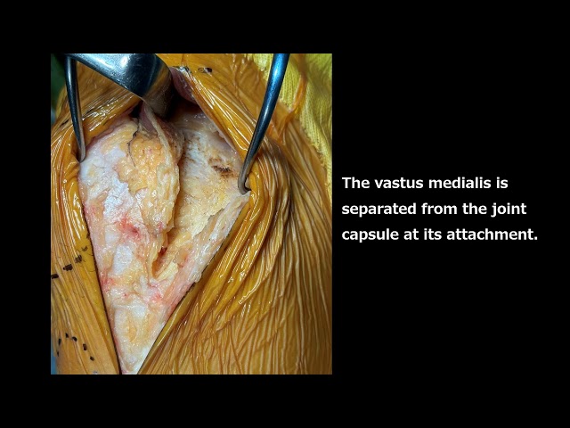 UVA (Under-vastus approach)