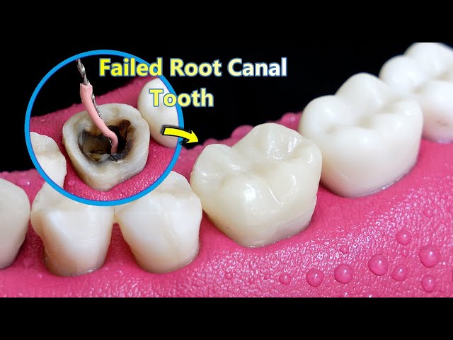 INCREDIBLE Reconstruction Of Poor/Failed Root Canal Treated Tooth.