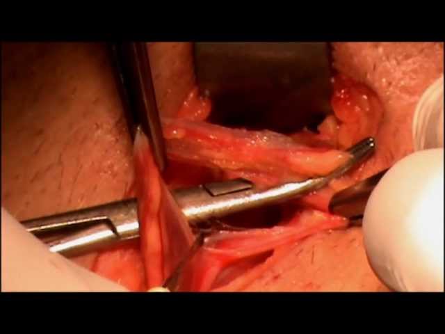 Varicocelectomy- A Bloodless Whitefield Surgical Dissection- R Talwar