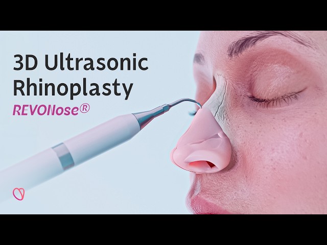 REVONose® – 3D Ultrasonic Feminization Rhinoplasty