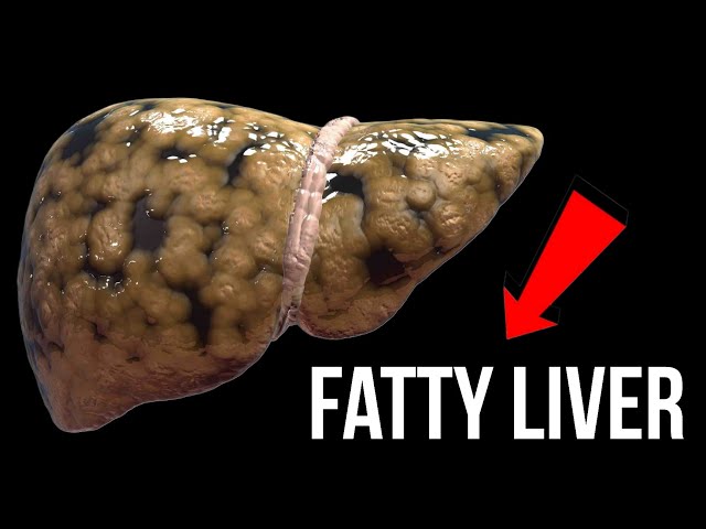 These are THE BEST Natural Remedies for Fatty Liver!