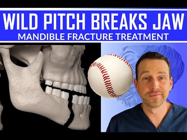 WILD PITCH BREAKS BATTER'S JAW | MANDIBLE FRACTURE TREATMENT