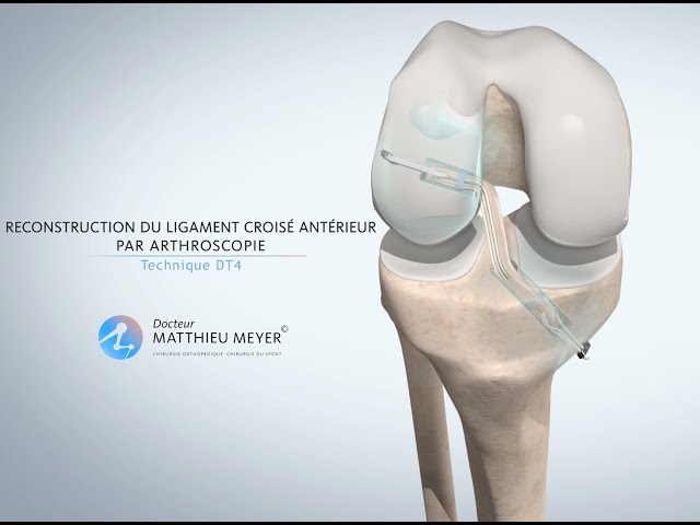 LIGAMENTOPLASTIE DU LIGAMENT CROISÉ ANTÉRIEUR PAR ARTHROSCOPIE (TECHNIQUE DT4) - DR MATTHIEU MEYER