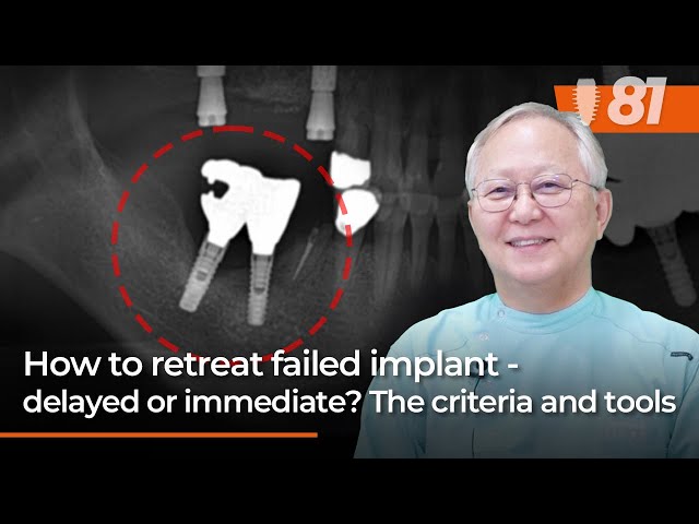 How to retreat failed implant - delayed or immediate? The criteria and tools