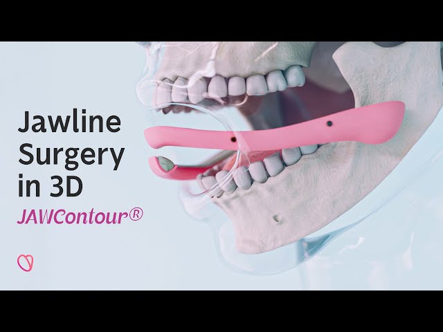 JAWContour® - Revolutionizing Jawline and Chin Surgery in 3D (Updated 2024)