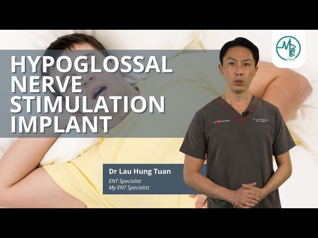 Hypoglossal Nerve Stimulation Implant | Dr Lau Hung Tuan (ENT Surgeon)