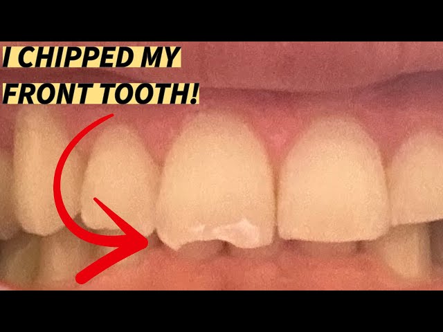 I CHIPPED MY FRONT TOOTH WRESTLING | Teeth Filing Procedure  | Pro Wrestling Documentary: Part 46