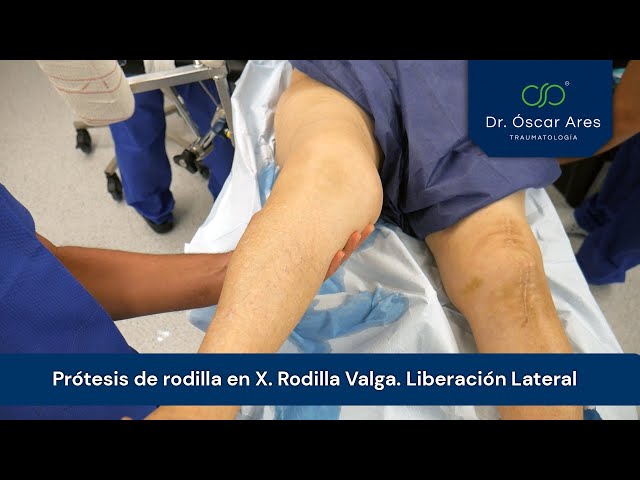 Prótesis de rodilla en X. Rodilla Valga. Liberación Lateral - Dr Oscar Ares