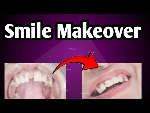 How Smile can change your personality || zirconia crown || ROOT canal Treatment || Smile Makeover