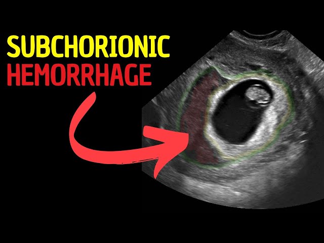 Subchorionic Hemorrhage: A Deep Dive into Ultrasound Diagnosis