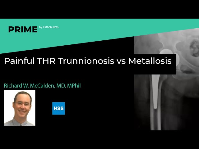 Painful THR Trunnionosis vs Metallosis - Richard W. McCalden, MD, MPhil (Edin), FRCSC