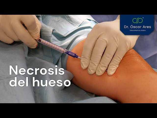 Necrosis del hueso - Dr. Oscar Ares