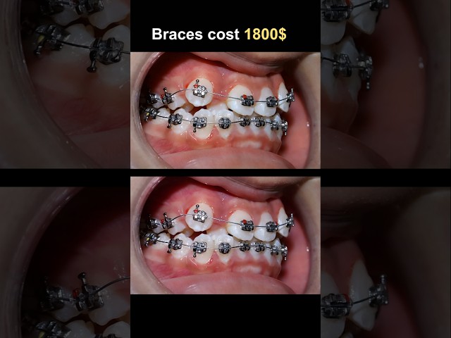 1800$ for crooked braces. This is resuit #braces #orthodontist #dentist