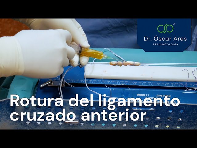 Rotura del Ligamento Cruzado Anterior - Dr. Oscar Ares