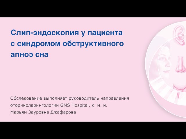 Слип-эндоскопия у пациента с cиндромом обструктивного апноэ сна видеориноларингоскопом KARL STORZ