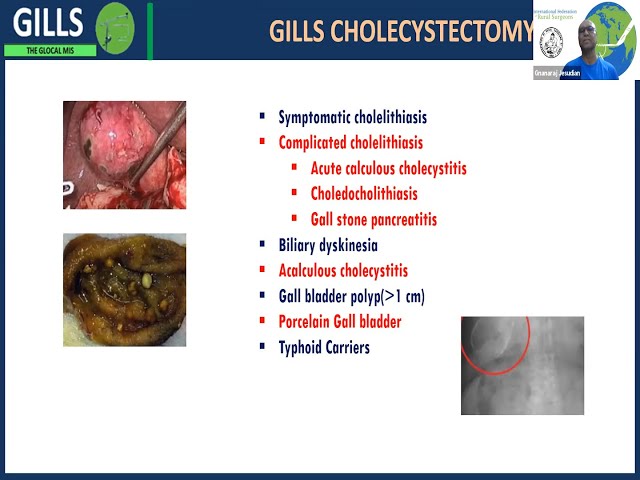 102) GILLS Cholecystectomy Summary