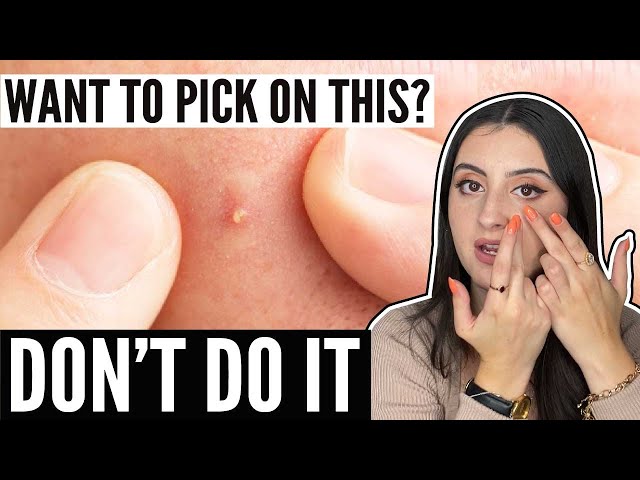 Skin Care Tips - Do You Pick Your Skin? Then WATCH THIS!