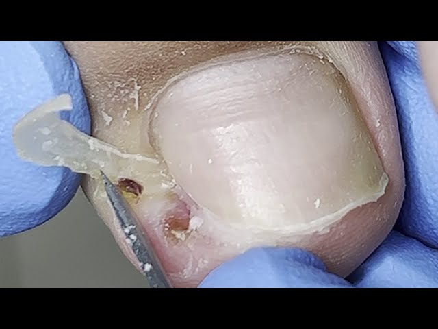 Strange ingrown nail location, causing red and swollen toes【Xue Yidao】