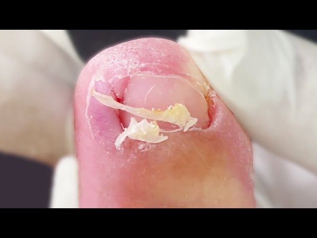 Ingrown toenail breaks deep in the toe，patient suffering【Foot scalpel】