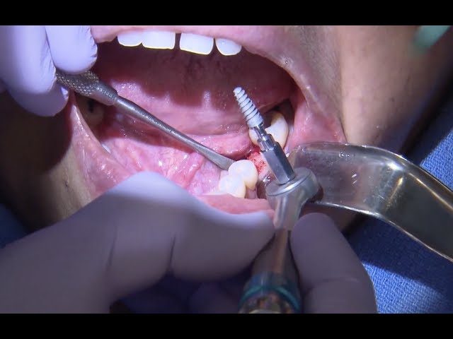 Case of the Week: The Fundamentals of Placing Implants