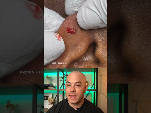 Doctor reacts to big cyst extraction on the ear! #dermreacts #doctorreacts #pimplepop #cystpop