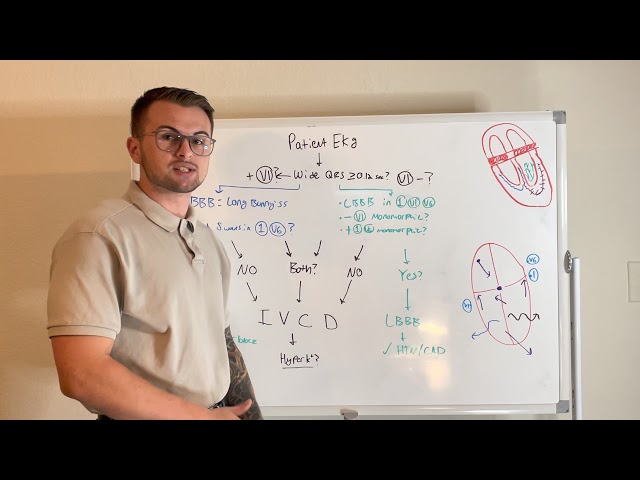 EKG Series: RBBB, LBBB, or IVCD? (Sadistic EKG Plinko)