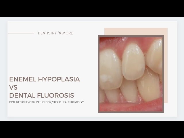 ENAMEL HYPOPLASIA vs DENTAL FLUOROSIS