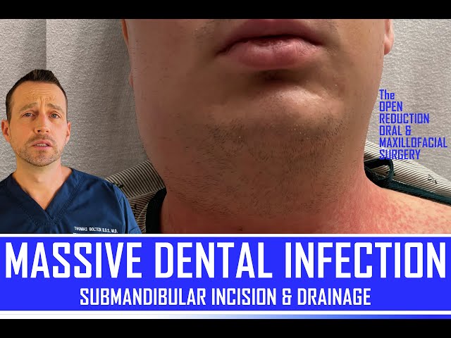 MASSIVE TOOTH INFECTION | DENTAL ABSCESS DRAINAGE