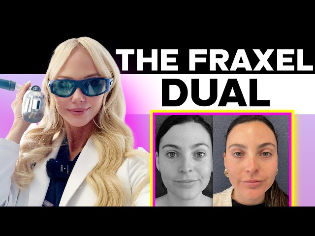 Why Fraxel Laser is my GO-TO Treatment for BEAUTIFUL Skin