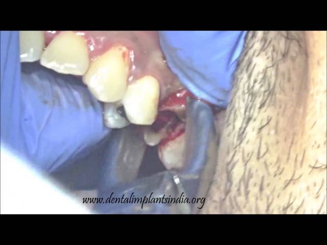 upper premolar tooth extraction(infected) and immediate roott implant placement