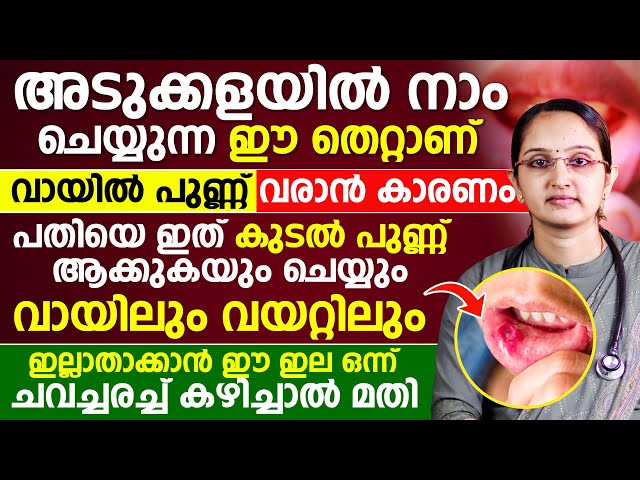 അടുക്കളയിൽ ചെയ്യുന്ന ഈ തെറ്റാണ് വായ്പുണ്ണ് വരാൻ കാരണം