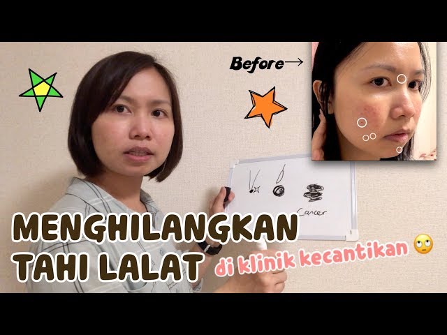 Menghilangkan Tahi Lalat di Klinik Kecantikan (di Jepang)