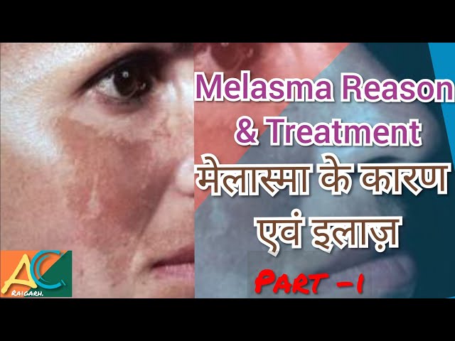 Melasma Reason and Treatment || मेलास्मा कारण और सही इलाज़