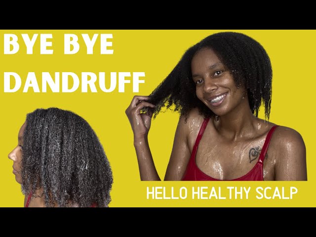 DRY SCALP AND DANDRUFF TREATMENT | NATURAL HAIR | WASH DAY