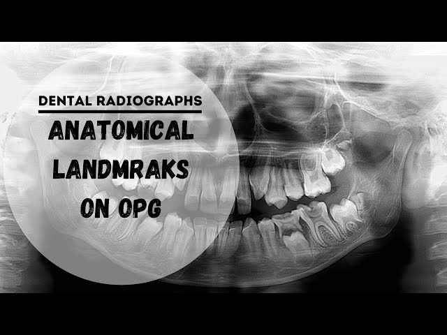 Dental panoramic radiographs | OPG  | DPT  Anatomical Landmarks