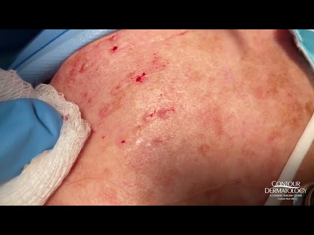 Milia and Whiteheads Extraction | CONTOUR DERMATOLOGY