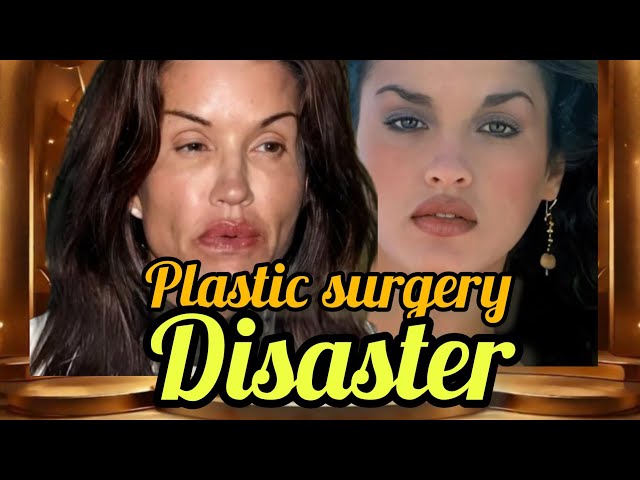 Hollywood’s Plastic Surgery Disasters: When Beauty Goes Too Far!