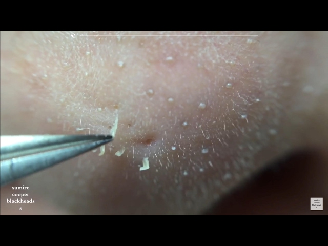 鼻角栓71nose blackheads★Tweezers only★