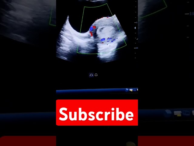 #ultrasound #missed abortion #viralvideo 😭😭😭