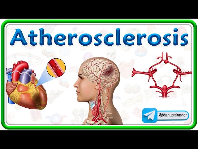 Atherosclerosis Pathology Animation: Causes, Pathogenesis, Risk factors, Complications: USMLE Step 1