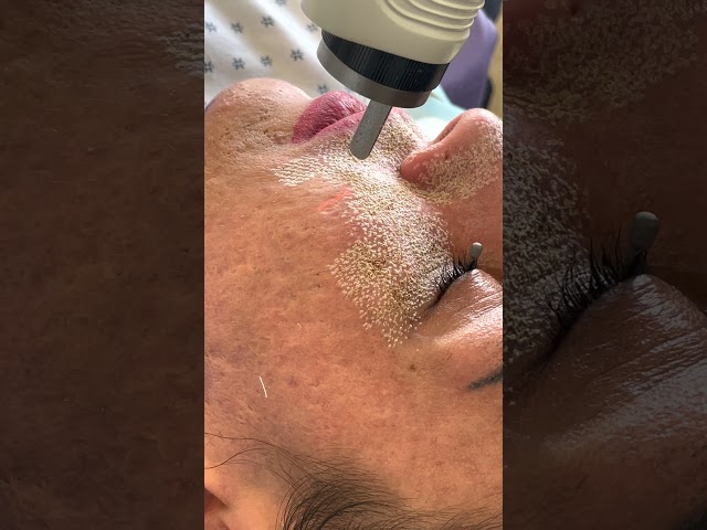 Fractional CO2 Laser Resurfacing