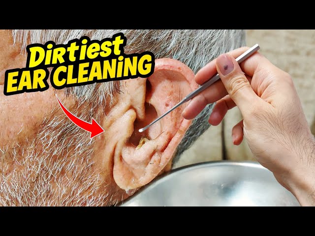 Dirtiest Ear Cleaning in the office #earcleaning #earwax #earwaxremoval