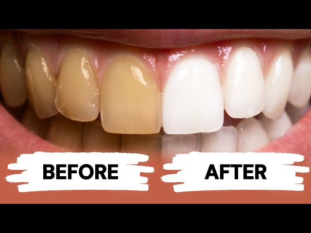 Teeth Whitening at Home