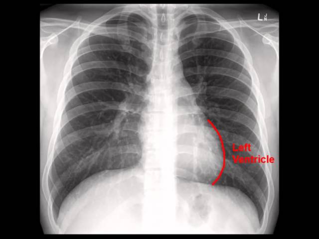 Chest X-Ray (CXR) Analysis in a Nutshell