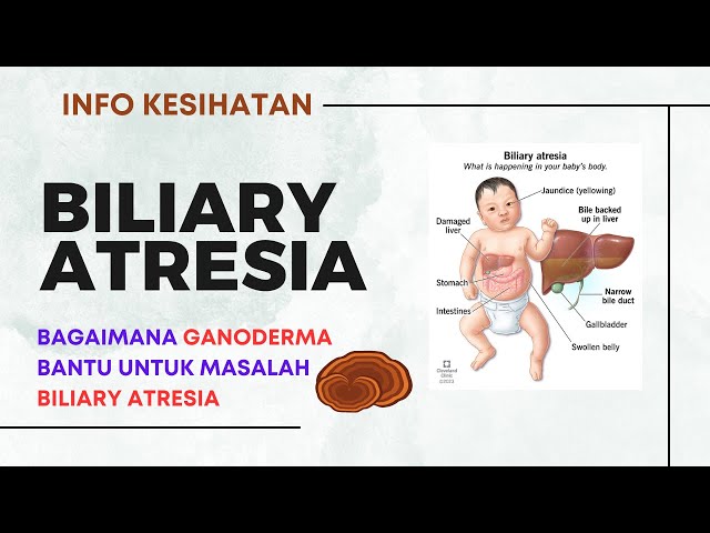 Bagaimana Ganoderma bantu untuk Masalah Biliary Atresia | Rawatan Alternatif