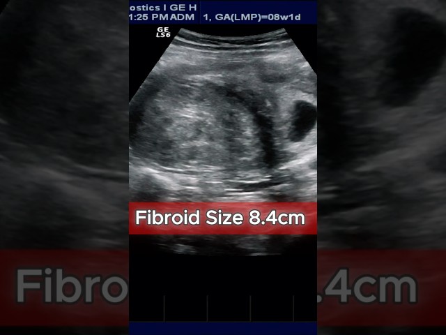 Large Fibroid with 8wks Pregnancy  ( 1 ) #ultrasound #pregnant #fibroids #compliation