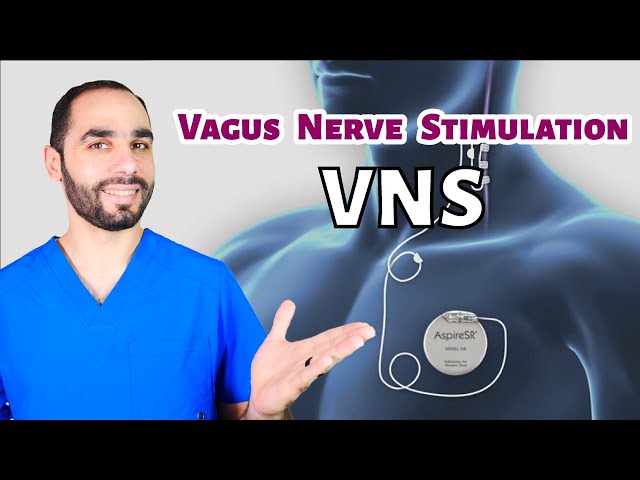 Vagus Nerve Stimulation (VNS) for Epilepsy