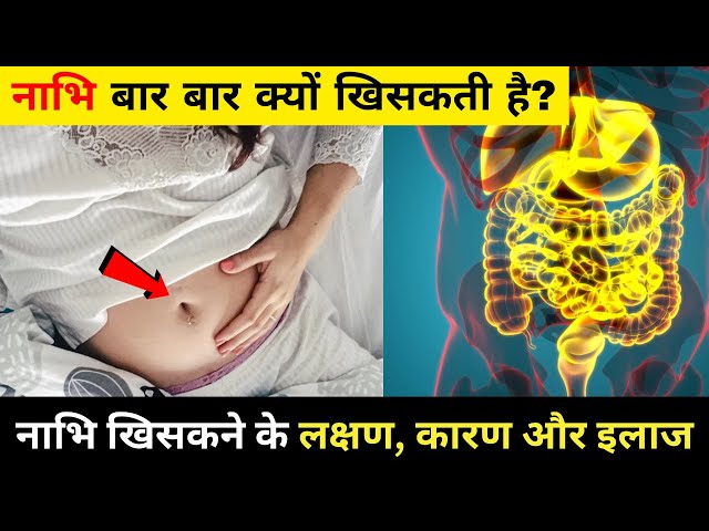 नाभि खिसकने के लक्षण, कारण और इलाज | Symptoms and causes of Naval Dislocation | wellness tips